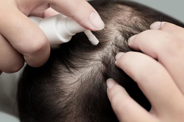 Alternative Treatment Options Minoxidil Itchy Scalp