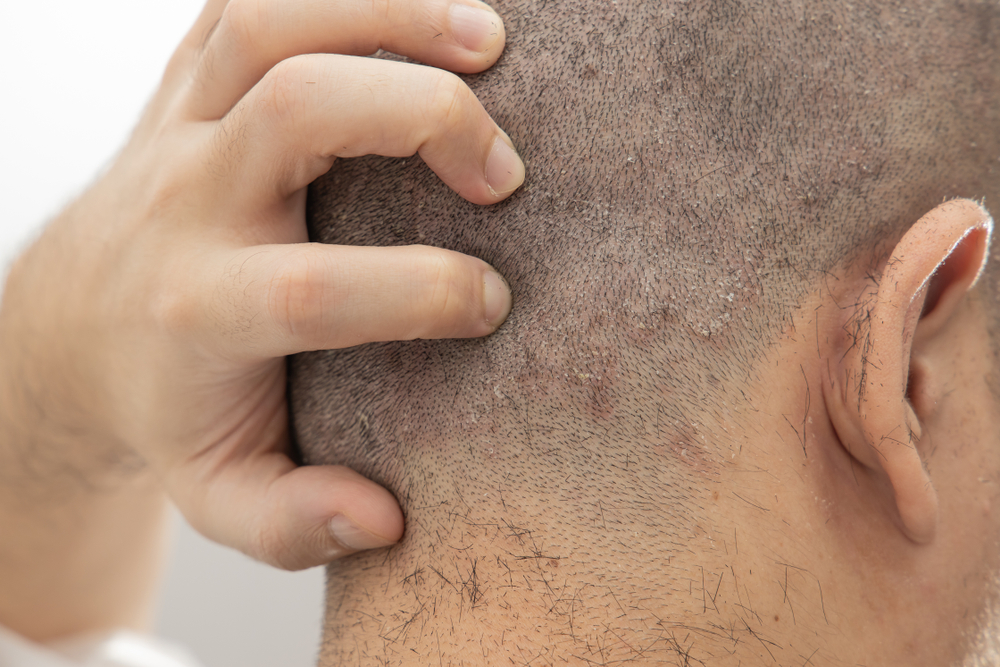 The Connection Between Minoxidil And Scalp Itchiness: