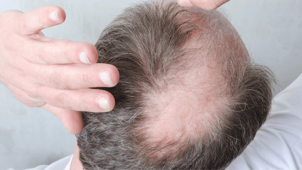 Understanding Minoxidil And Its Effects: