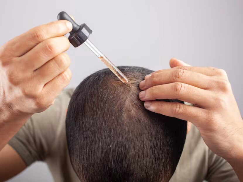 What Is Minoxidil